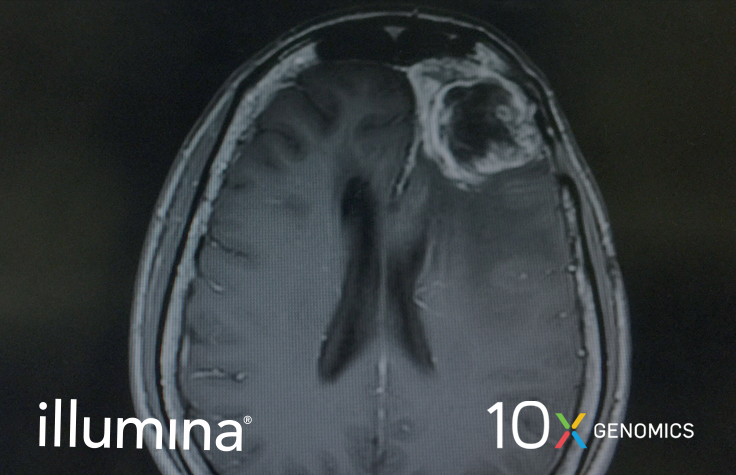 Immune Profiling of Human Tumors Identifies CD73 as a Combinatorial Target in Glioblastoma